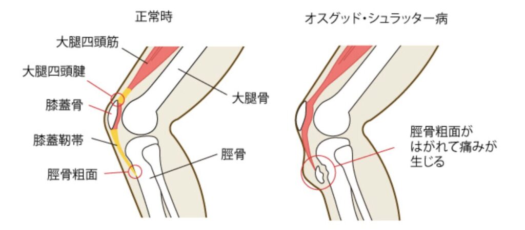 オスグッド・シュラッター病